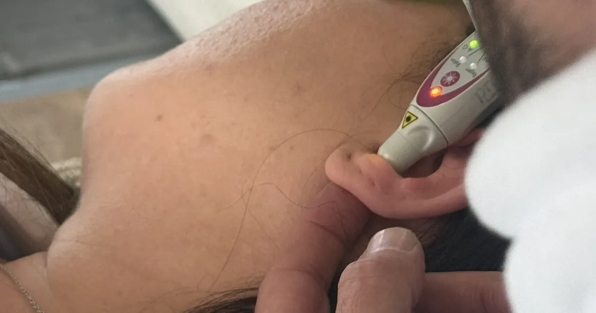 Laser auriculaire posé sur l'oreille d'une patiente pendant une séance de sevrage tabac au cabinet de Cranves-Sales